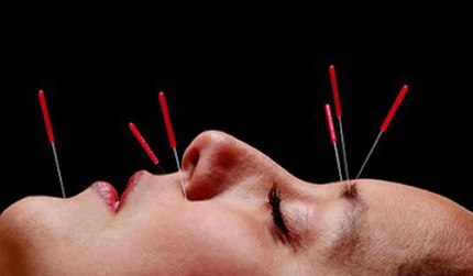 Acupuncture2